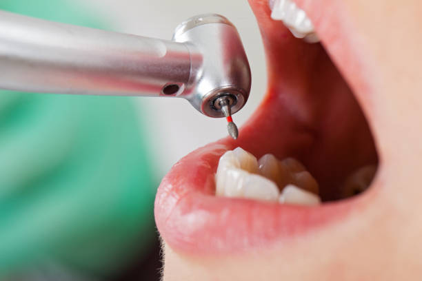Best Emergency Dental Extractions in Rson, CA